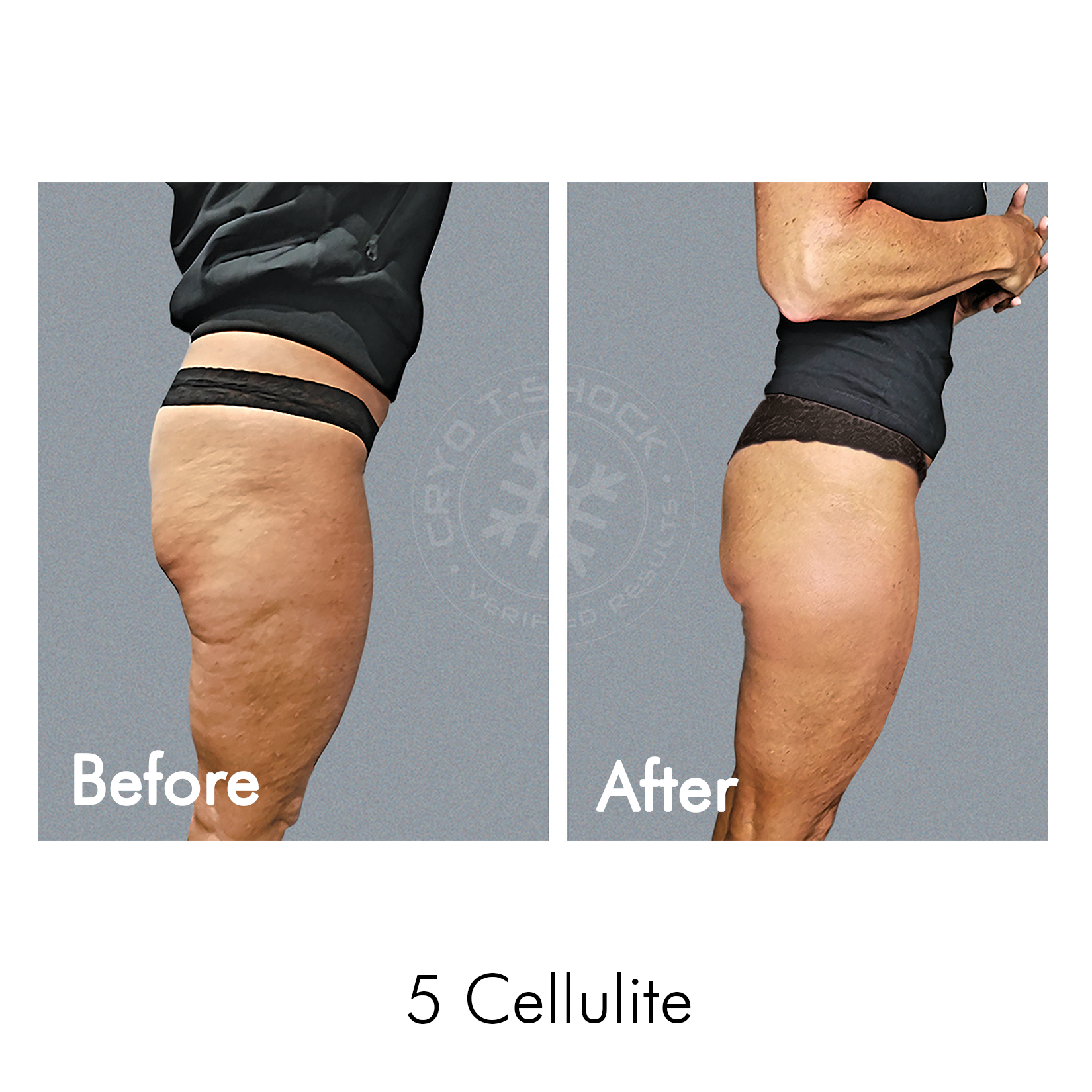 Cryo T-Shock Body Sculpting (Large Body Area) 5 & 10 Pack