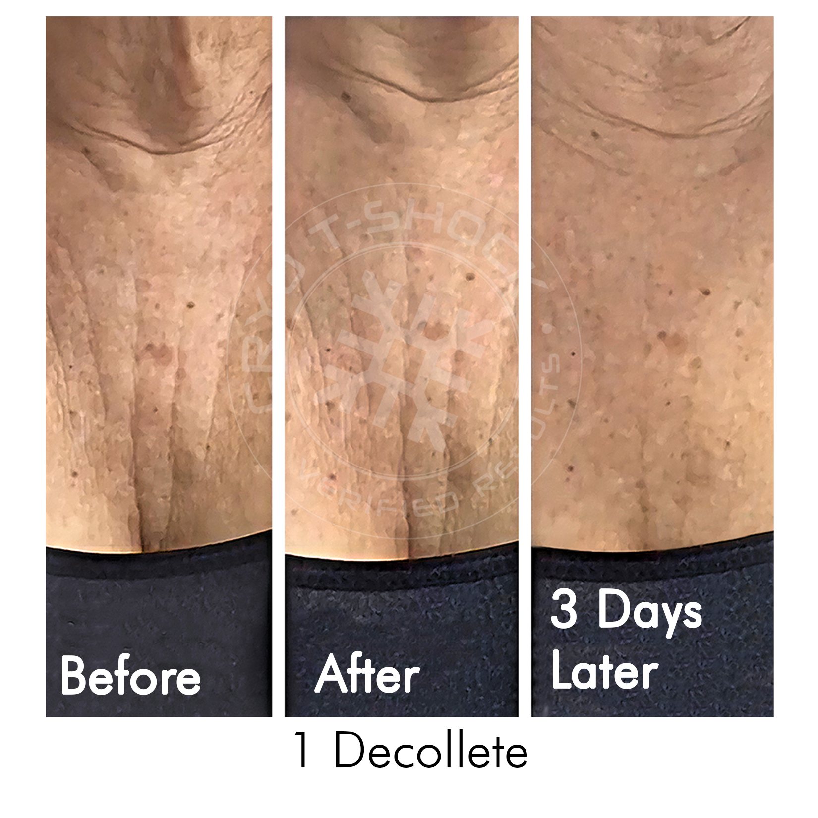 Cryo T-Shock Facial (Small Body Area) 5 & 10 Pack