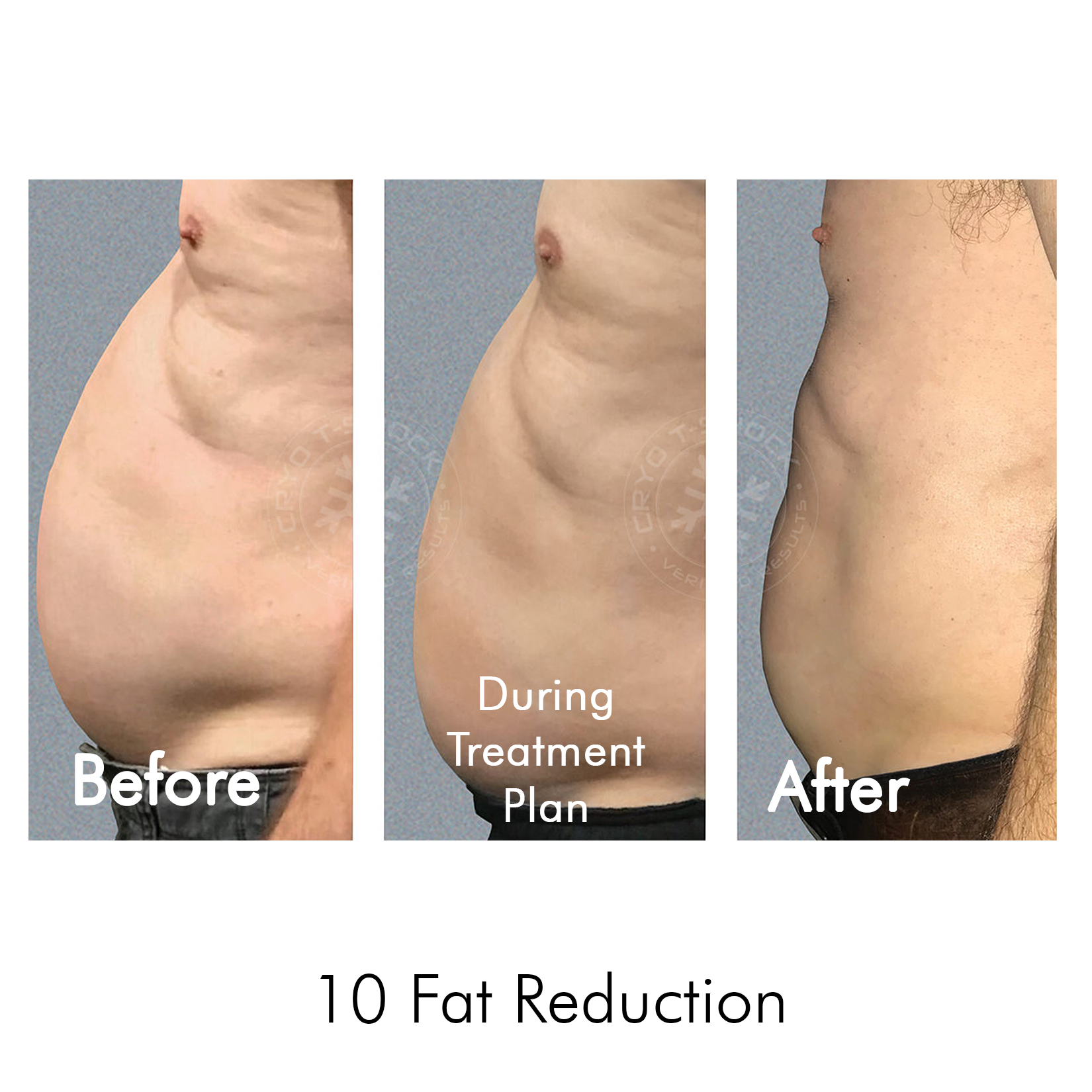 Cryo T-Shock Body Sculpting (Large Body Area) 5 & 10 Pack