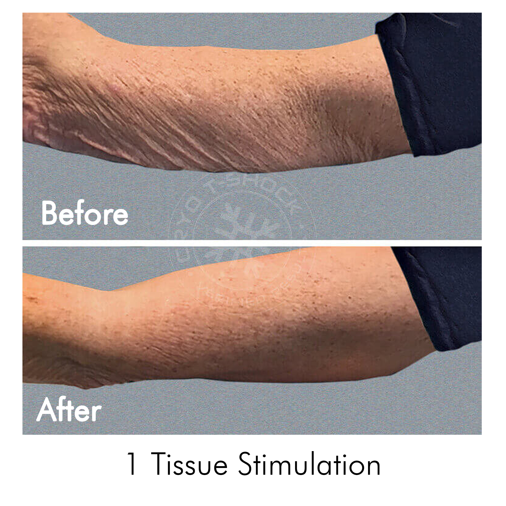 Cryo T-Shock Facial (Small Body Area) 5 & 10 Pack