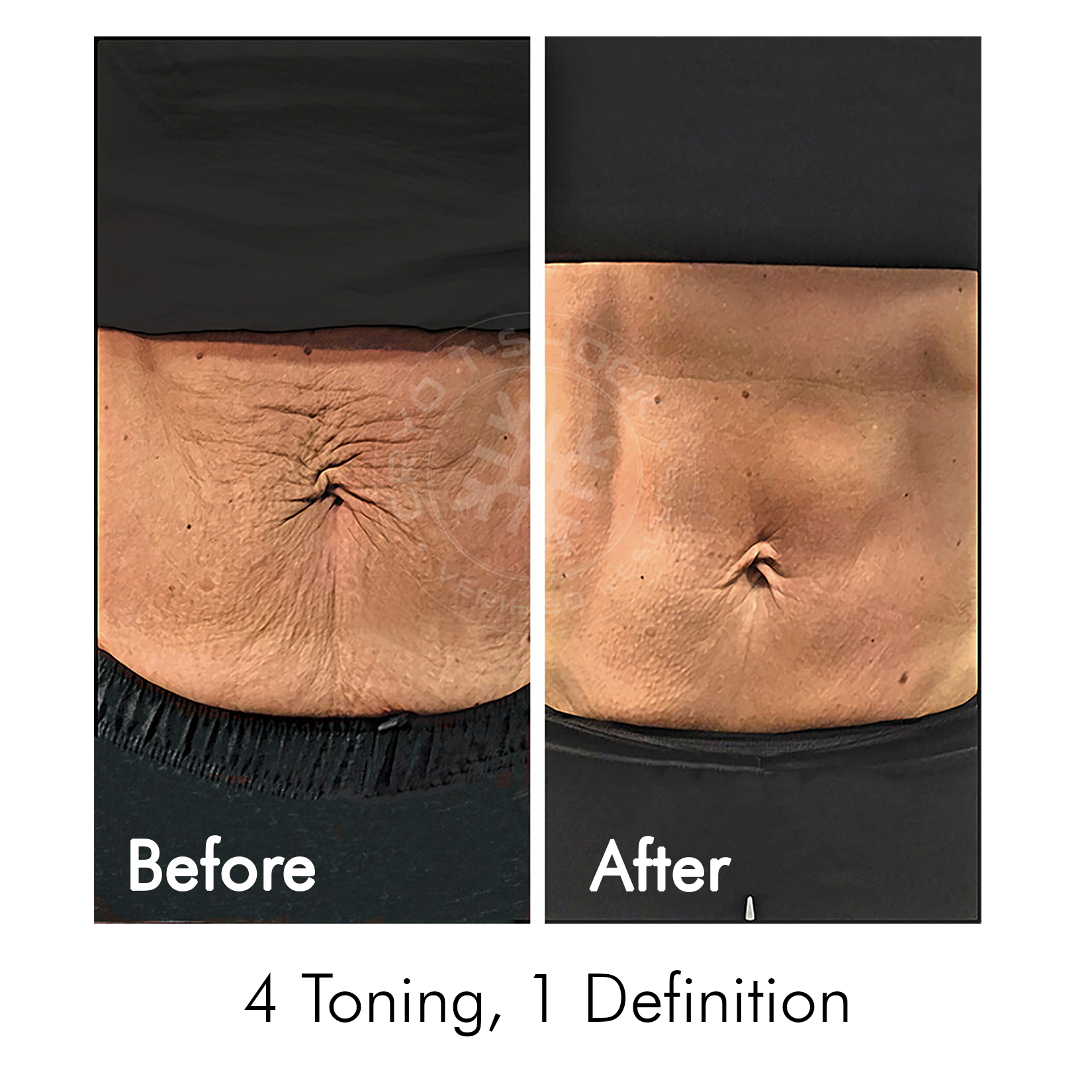 Cryo T-Shock Body Sculpting (Large Body Area) 5 & 10 Pack