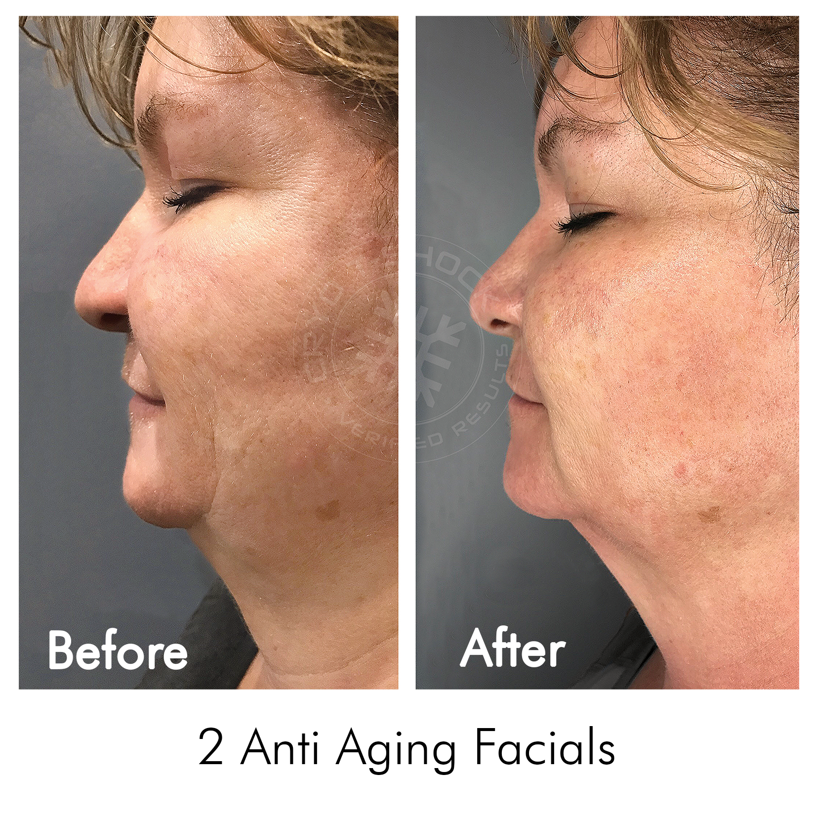 Cryo T-Shock Facial (Small Body Area) 5 &amp; 10 Pack