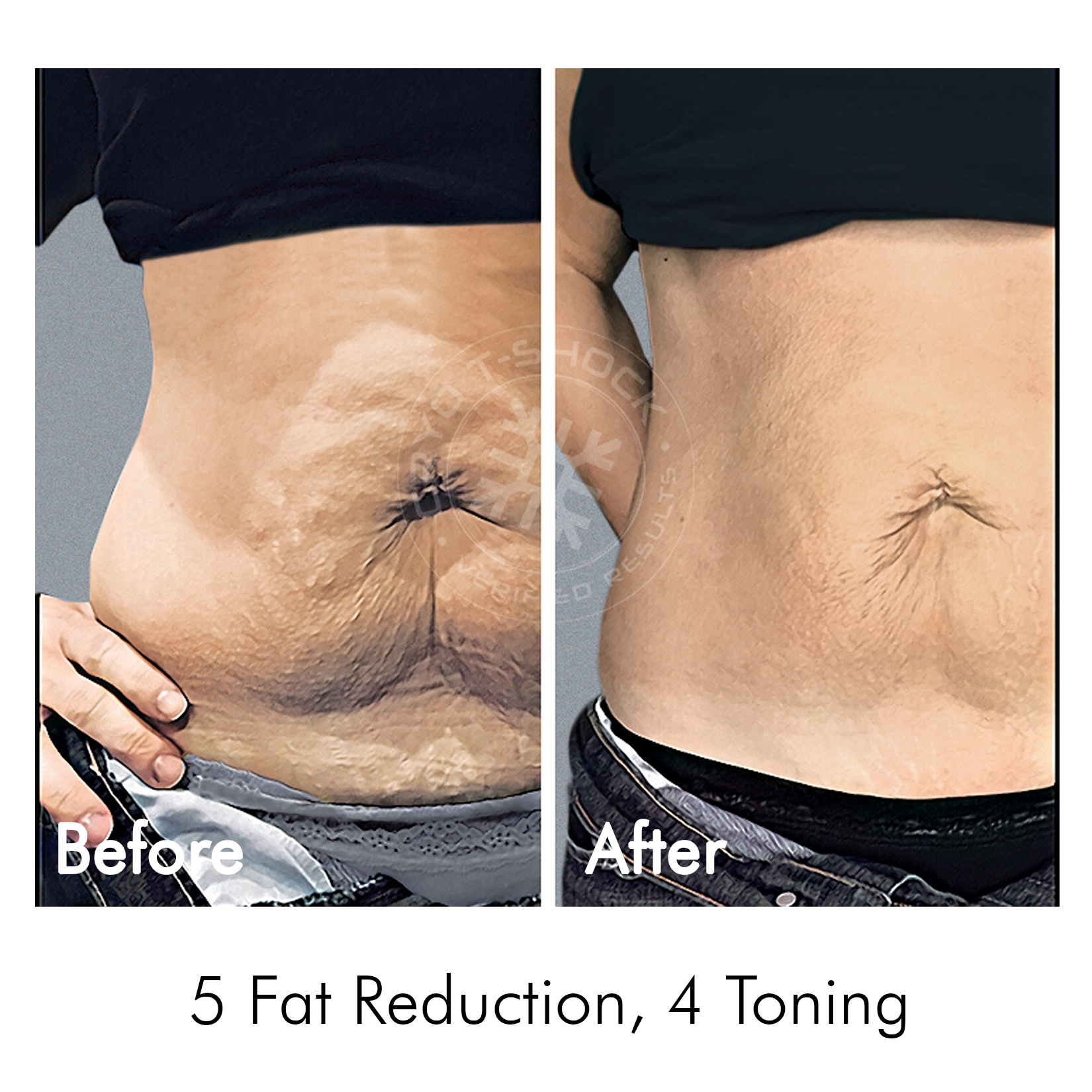 Cryo T-Shock Body Sculpting (Large Body Area) 5 &amp; 10 Pack